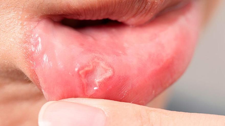 Adiós a las llagas: el método definitivo para deshacerte de ellas