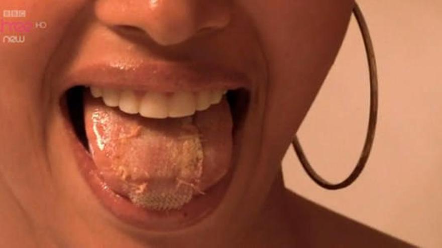 Lengua cosida para no comer