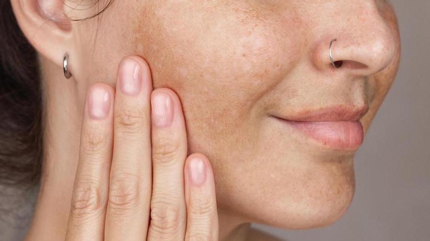 Manchas en la piel: cómo prevenirlas antes y después del verano