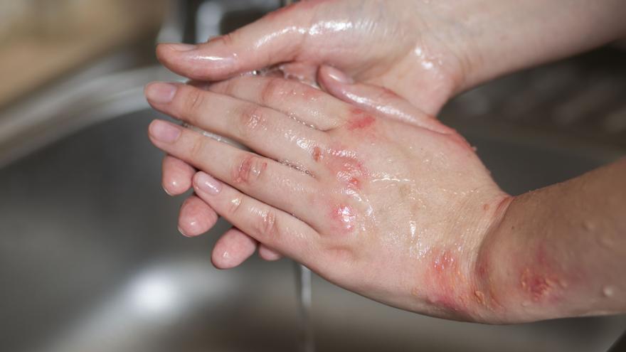 Un fármaco para la leucemia reduce los síntomas de la psoriasis