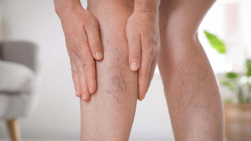 Detectar las varices a tiempo, clave para frenar su avance