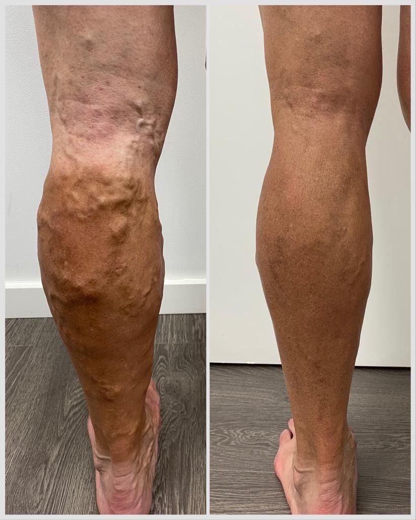 Antes y después de un tratamiento de varices sin cirugía.