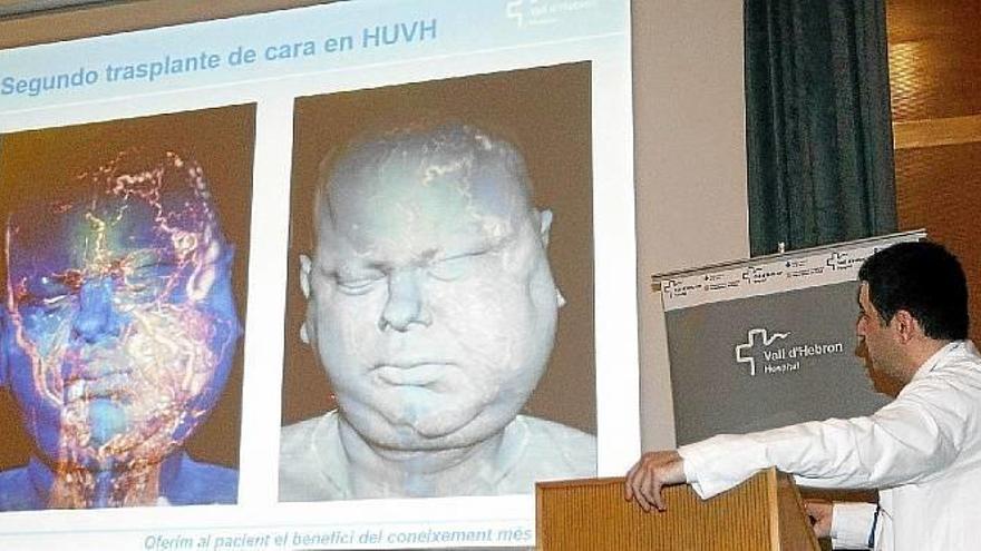 Trasplantan la cara a un hombre con una grave malformación
