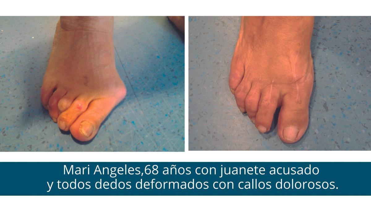 Mari Ángeles, de 68 años, con juanete acusado y todos los dedos deformados con callos dolorosos