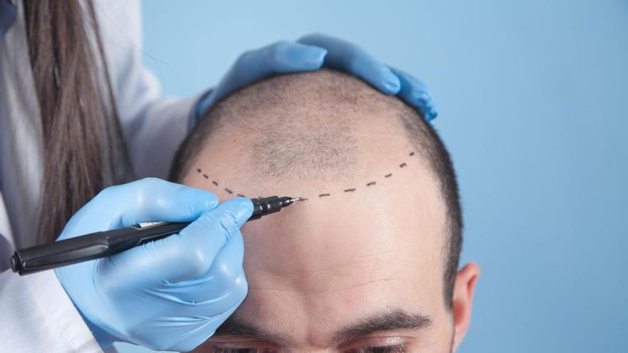 Injerto capilar: lo que casi nadie pregunta y todo el mundo quiere saber