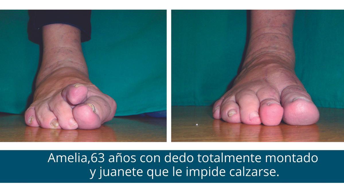Amelia, de 63 años, con un dedo totalmente montado y juanete que le impide calzarse