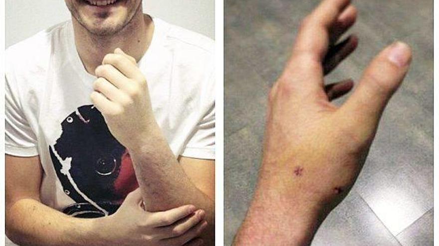 Fotografías colgadas hoy por el portero del Real Madrid, Iker Casillas (i), en su Twitter en las que se ve el estado de su mano izquierda tras quitarle la escayola que ha llevado durante varios días