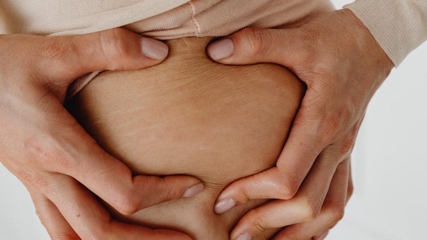 Despídete a las estrías: ¿cuándo es el mejor momento para tratarlas? Un dermatólogo tiene la respuesta