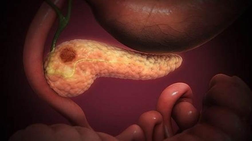 Desarrollan un algoritmo que predice metástasis en cáncer de páncreas y ayudará a evitar cirugías innecesarias