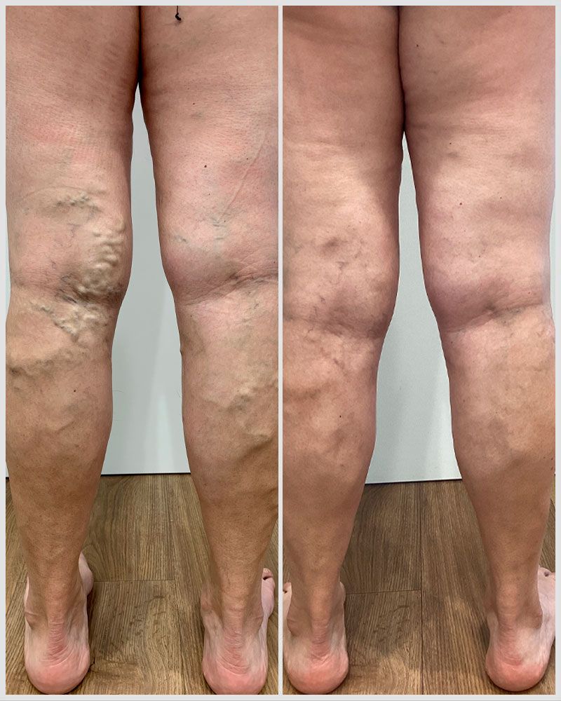 Piernas con varices antes del tratamiento y después.
