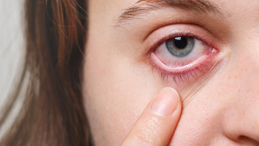 ¿Cómo reducir las molestias asociadas al síndrome del ojo seco?