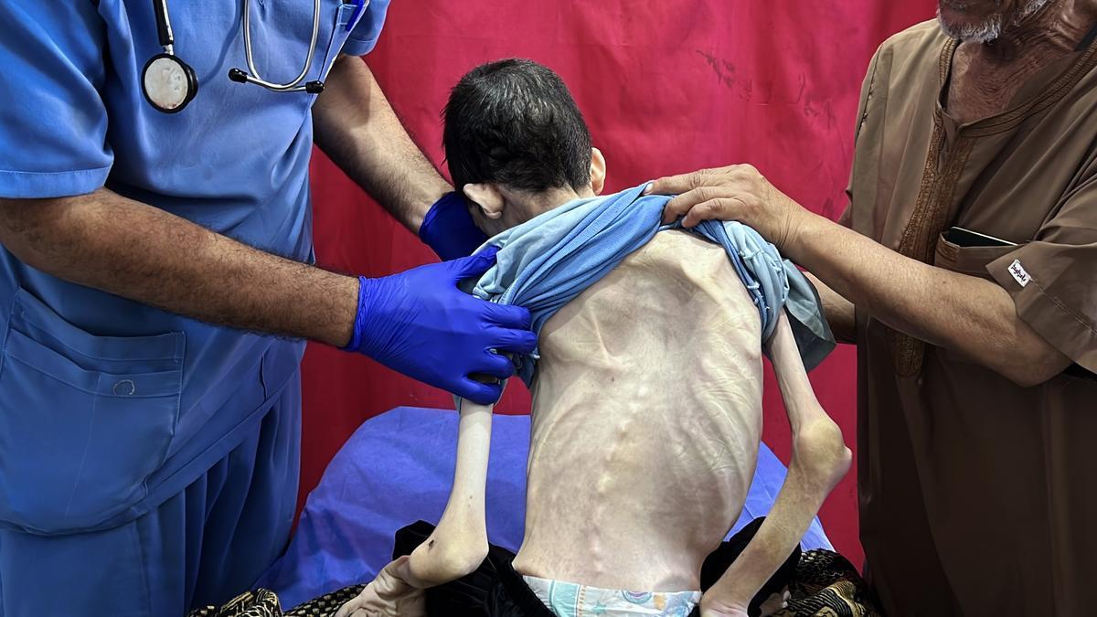 Inspeccionan el cuerpo del palestino Karam Khaled al-Jamal, de 25 años, que perdió la vida debido a la desnutrición.