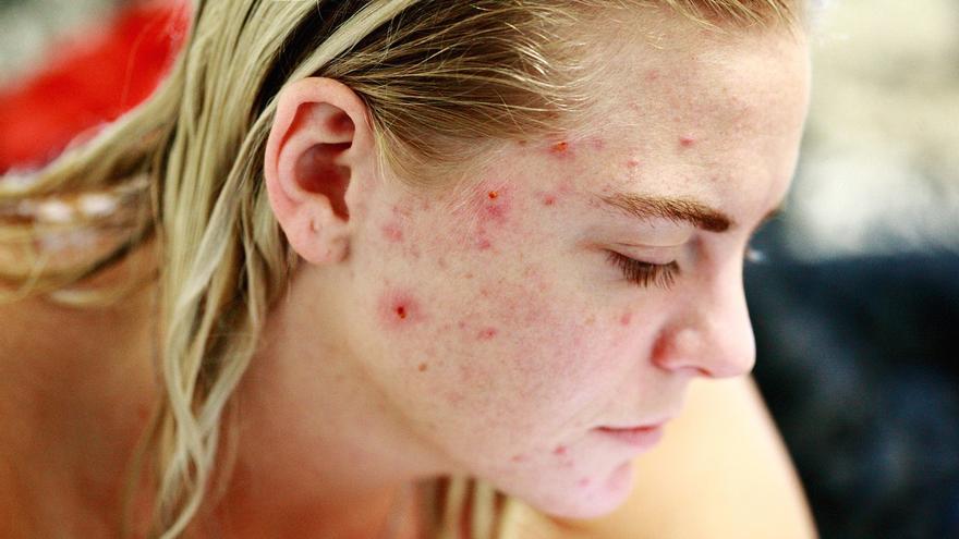 El cáncer de piel más frecuente y que pasa desapercibido: todo lo que debes saber