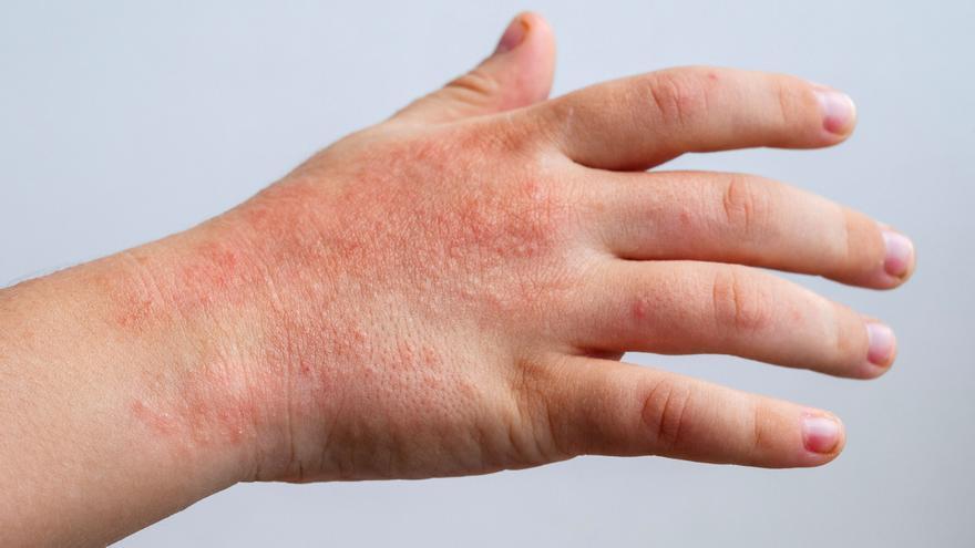 Eccemas: qué son y cuáles son las pautas de higiene para tratarlos