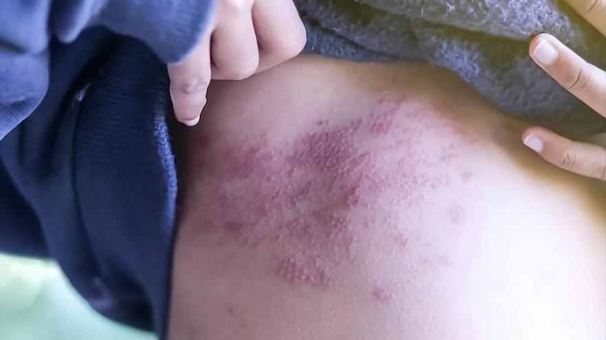Herpes zóster: el inesperado regreso del virus de la varicela en la edad adulta