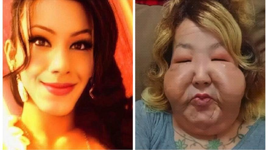Una influencer intenta reconstruir su rostro, deformado tras una operación estética clandestina