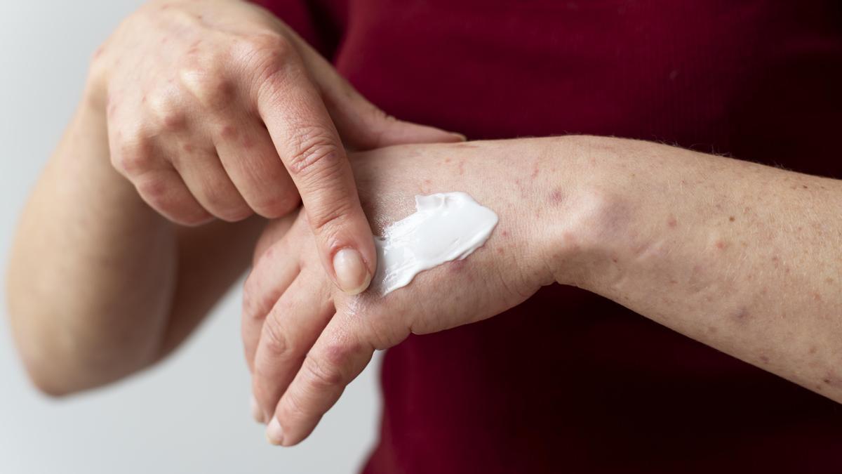 Una persona aplica crema para tratar una quemadura en su mano.