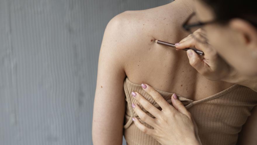 La prevención, el gran desafío en el cáncer cutáneo