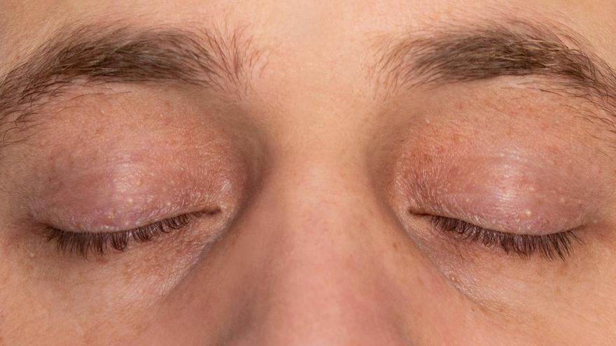 ¿Tienes bolitas blancas en la cara? Descubre qué es un quiste de milium y cómo quitarlo