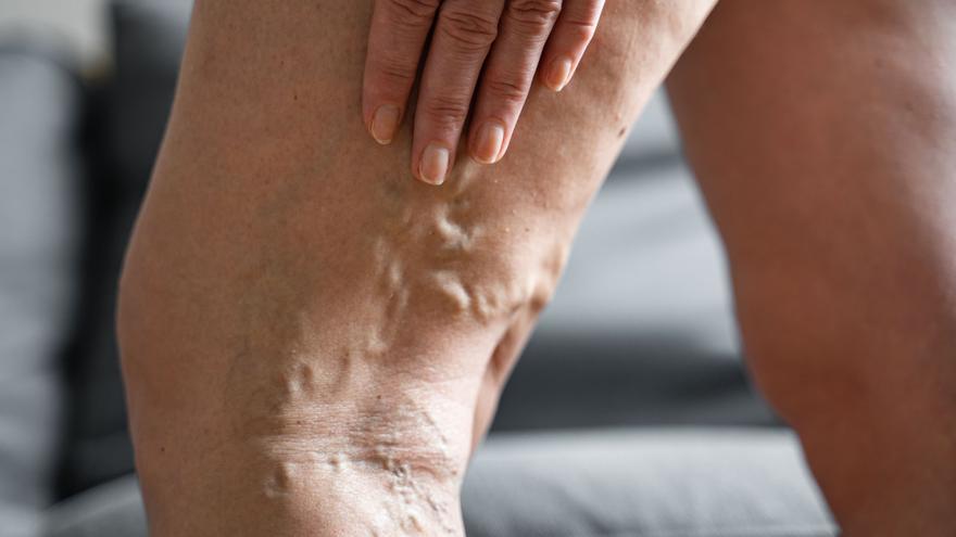 Varices sin cirugía: la radiología intervencionista está cambiando el tratamiento de la insuficiencia venosa