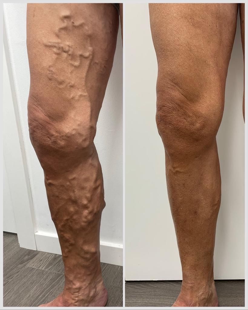 Imagen del antes y después del tratamiento de varices en un paciente.
