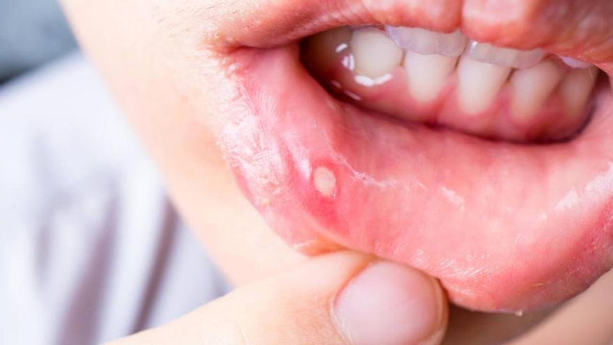 Jorge Ángel, enfermero: &quot;Las aftas aparecen por estrés o un deterioro del sistema inmunitario&quot;