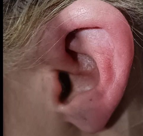 Imagen de la oreja de Amaya Zabarte tras los hechos facilitada por la familia.