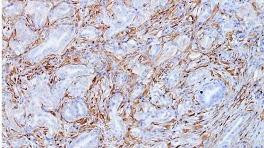 Un sistema pone cifras al impacto del cáncer en el Estado: los distintos tipos de tumores malignos, a examen