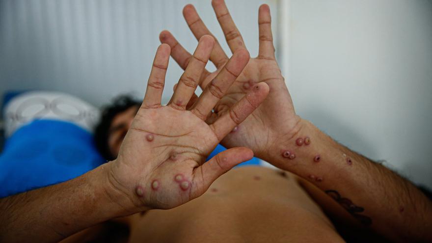 Galicia registra un nuevo brote de viruela del mono sin un origen claro