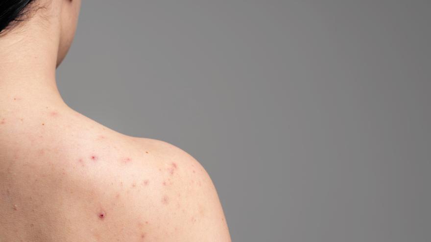 Adiós a los granos de la espalda: un dermatólogo explica la solución