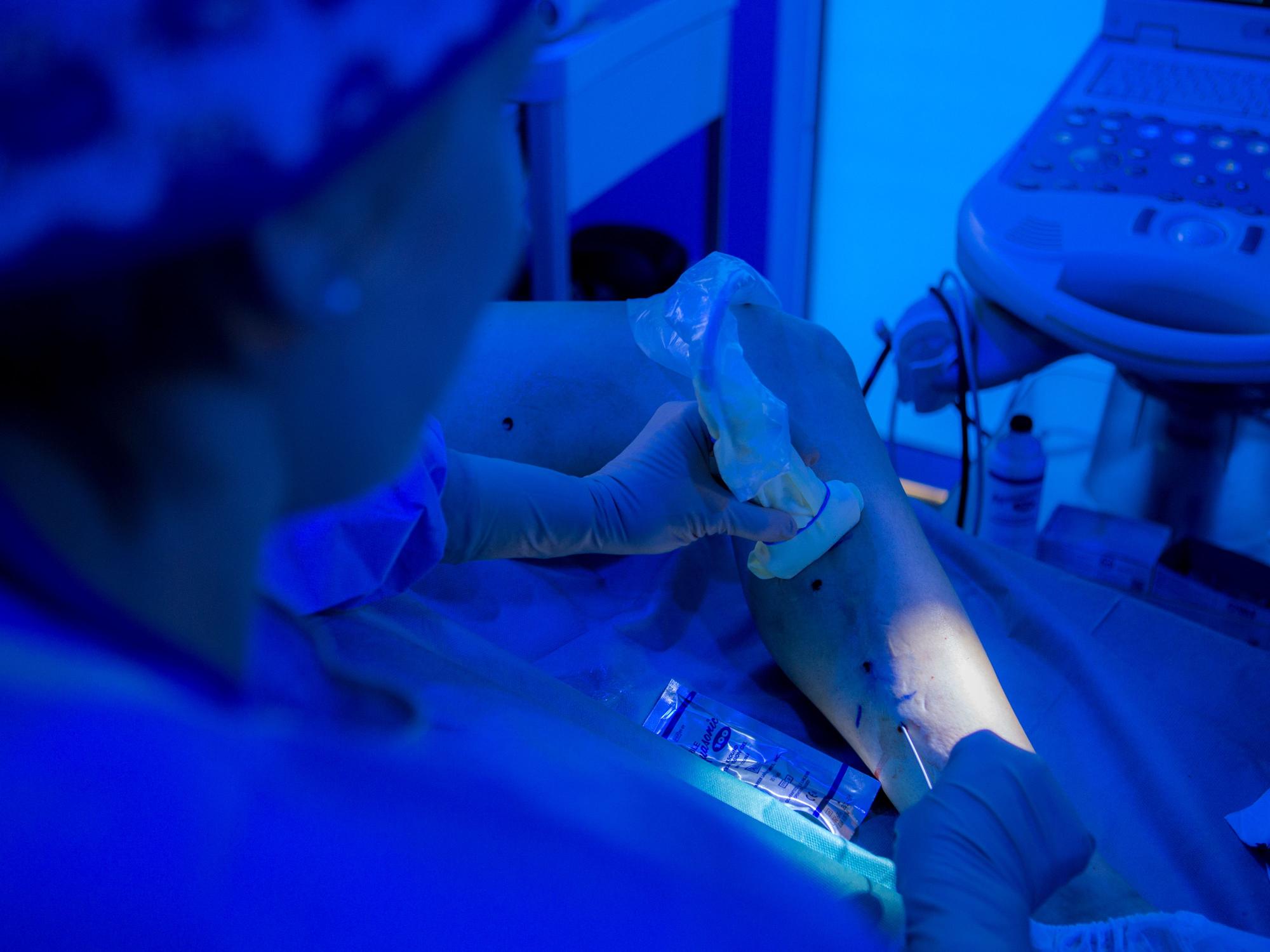 Tratamiento con láser endovenoso en la Clínica Dermitek.