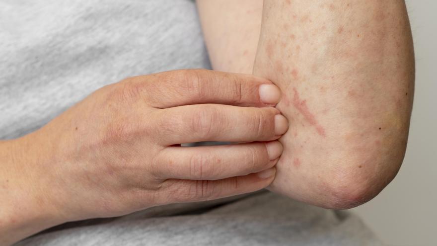Urticaria crónica: síntomas y cómo afecta la calidad de vida