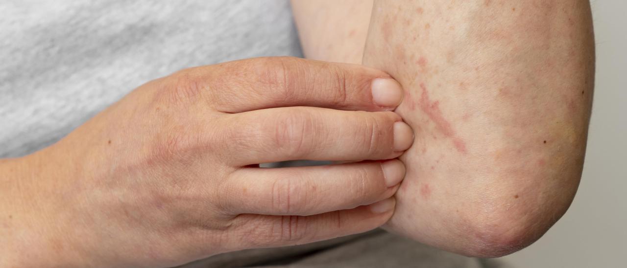Urticaria crónica: síntomas y cómo afecta la calidad de vida