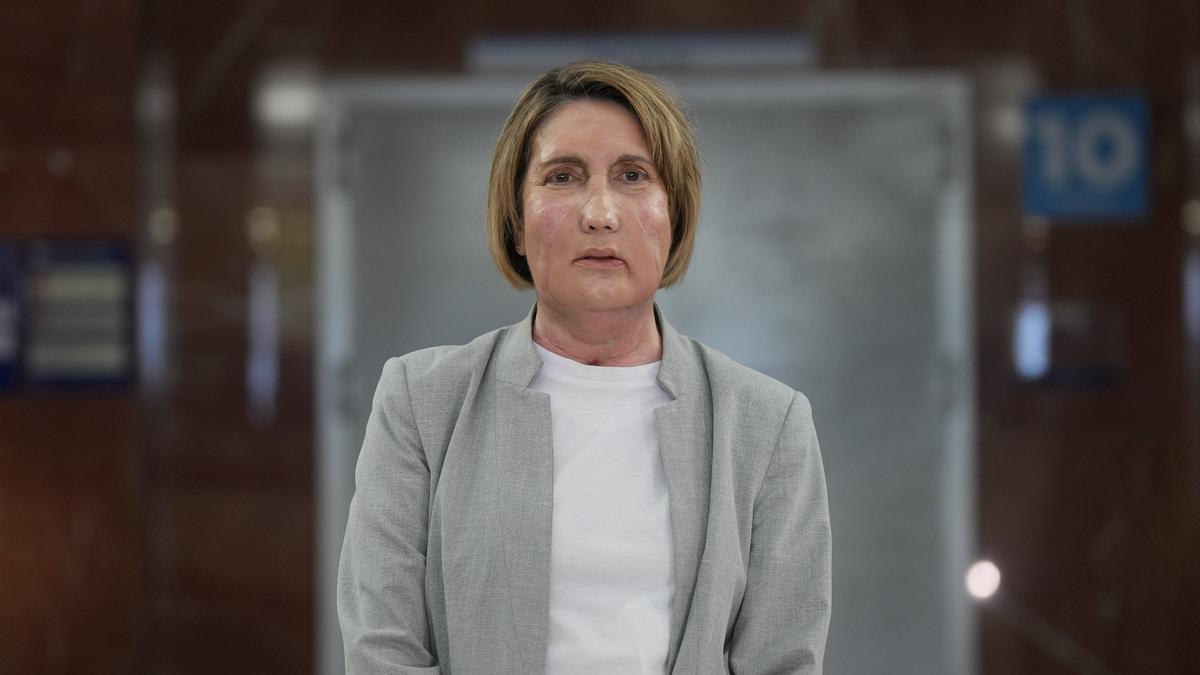 Carme, primera persona en el mundo a la que se realiza un trasplante de cara a partir de una donante que recibió la eutanasia.