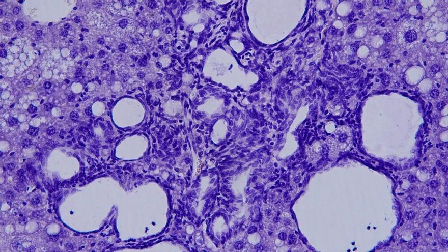 Una investigación de CIC bioGUNE halla una nueva vía para tratar un cáncer de hígado raro y agresivo