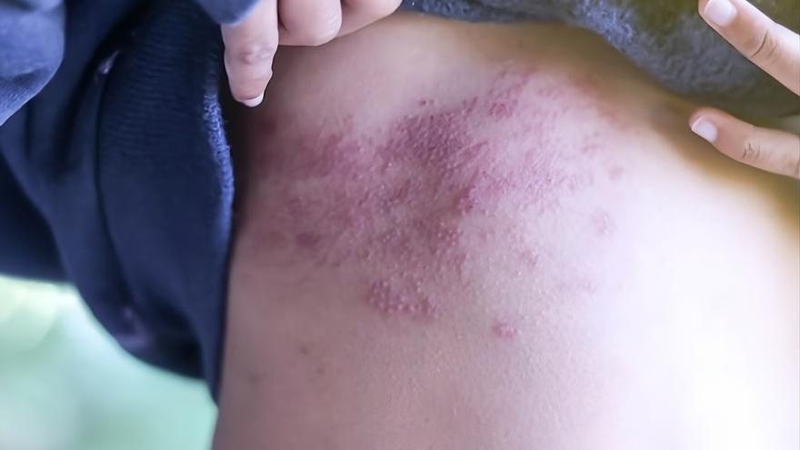 Herpes Zóster: el inesperado regreso del virus de la varicela en la edad adulta