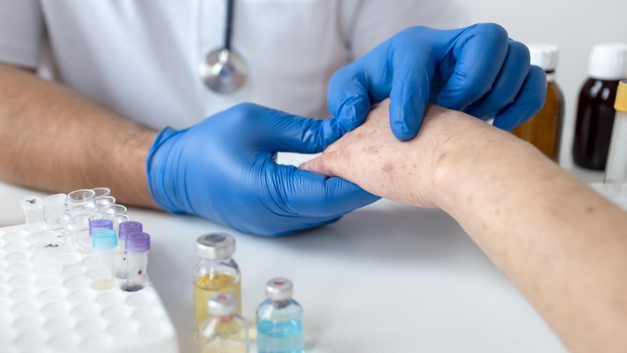 Alertan de los contagios por lepra a nivel mundial, aunque Navarra solo ha detectado un caso en la última década