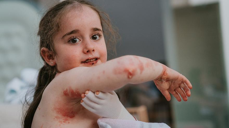 Euskadi pedirá al Ministerio de Sanidad que financie el elevado coste del tratamiento de la piel de mariposa