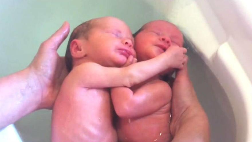 Dos gemelos se niegan a separarse después de nacer
