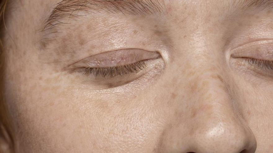 Ana Molina, dermatóloga, sobre la aparición de las pecas: "Si te salen, es porque 'pecas'"