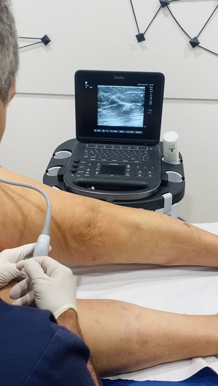 Tratamiento de varices con escleroterapia.