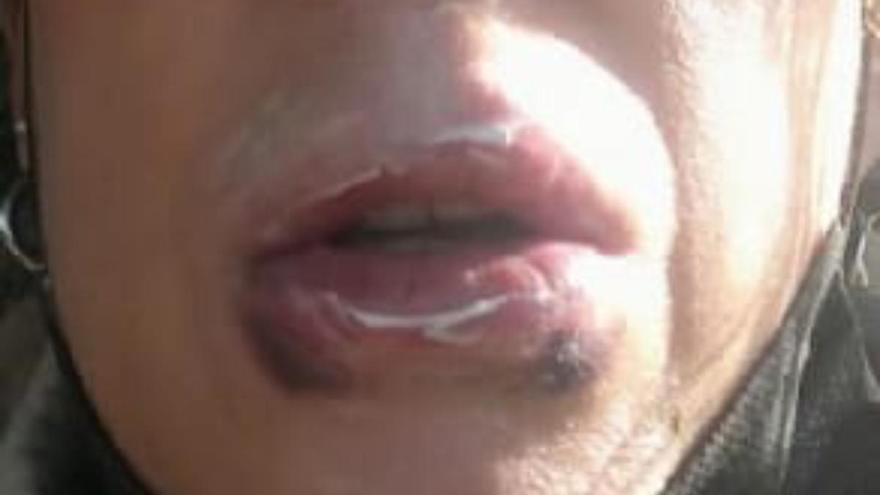 Investigan a una clínica estética de Pamplona por aumentar labios con ácido hialurónico ilegal