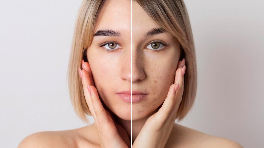 Estos son los alimentos que provocan acné, según una dermatóloga