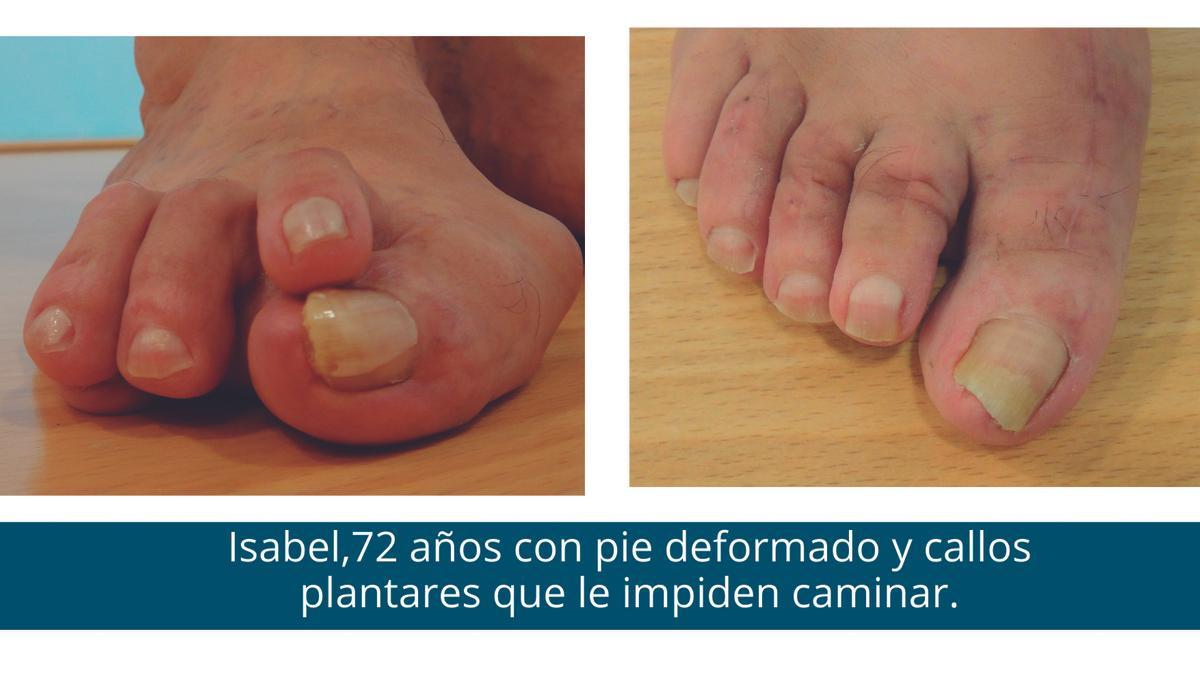 Isabel, de 72 años, con un pie deformado y callos plantares que le impiden caminar