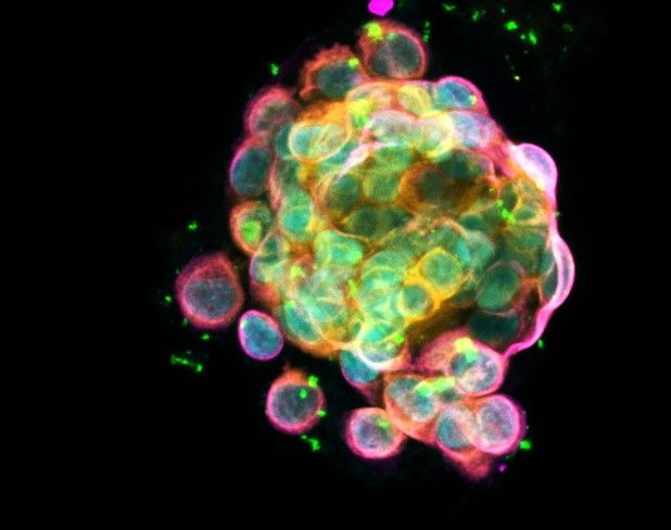 Imagen de un tumor en el microscopio