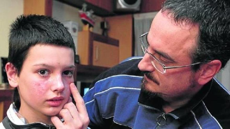 Juanma Gallego, padre de Unai, observa las graves quemaduras provocadas por el petardo en el rostro de su hijo el día de Año Nuevo.