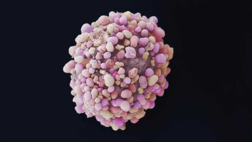 El cáncer de mama, el de mayor impacto entre las mujeres. 