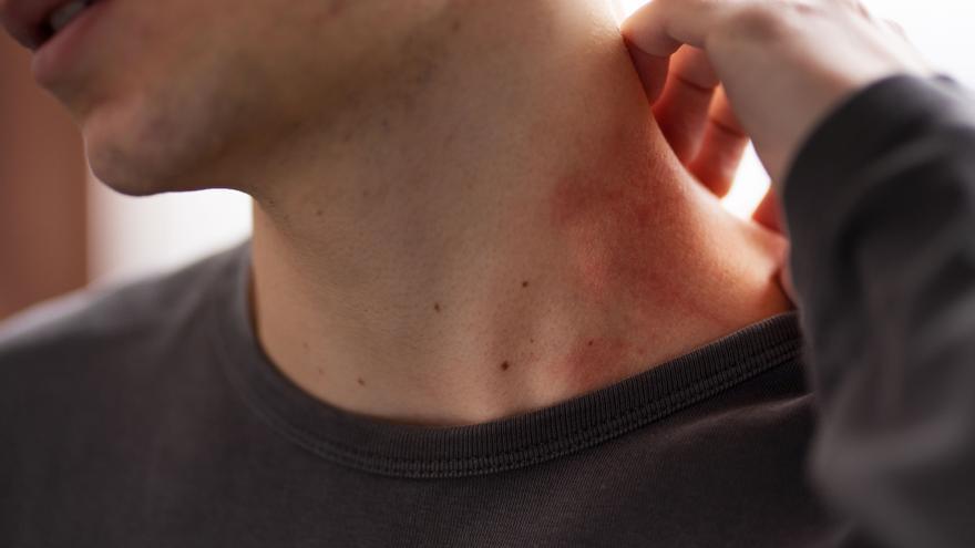 ¿Qué insecto te ha picado? Descúbrelo por el tipo de picadura que es